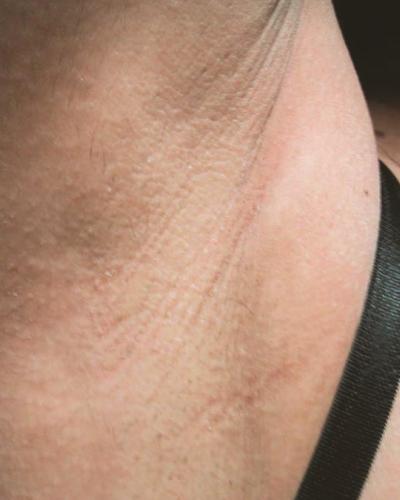 laser removal hair nwa gentle pro