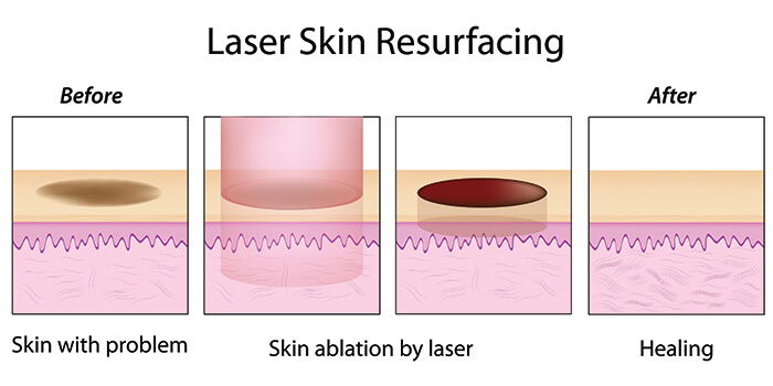 laser-skin-resurfacing